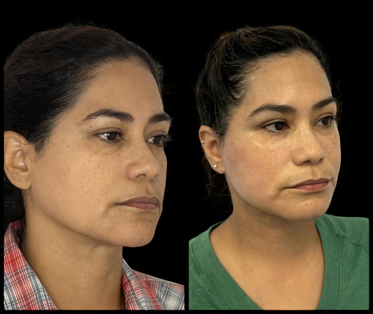 Deep Plane Facelift Before & After Gallery - Patient 418167 - Image 2