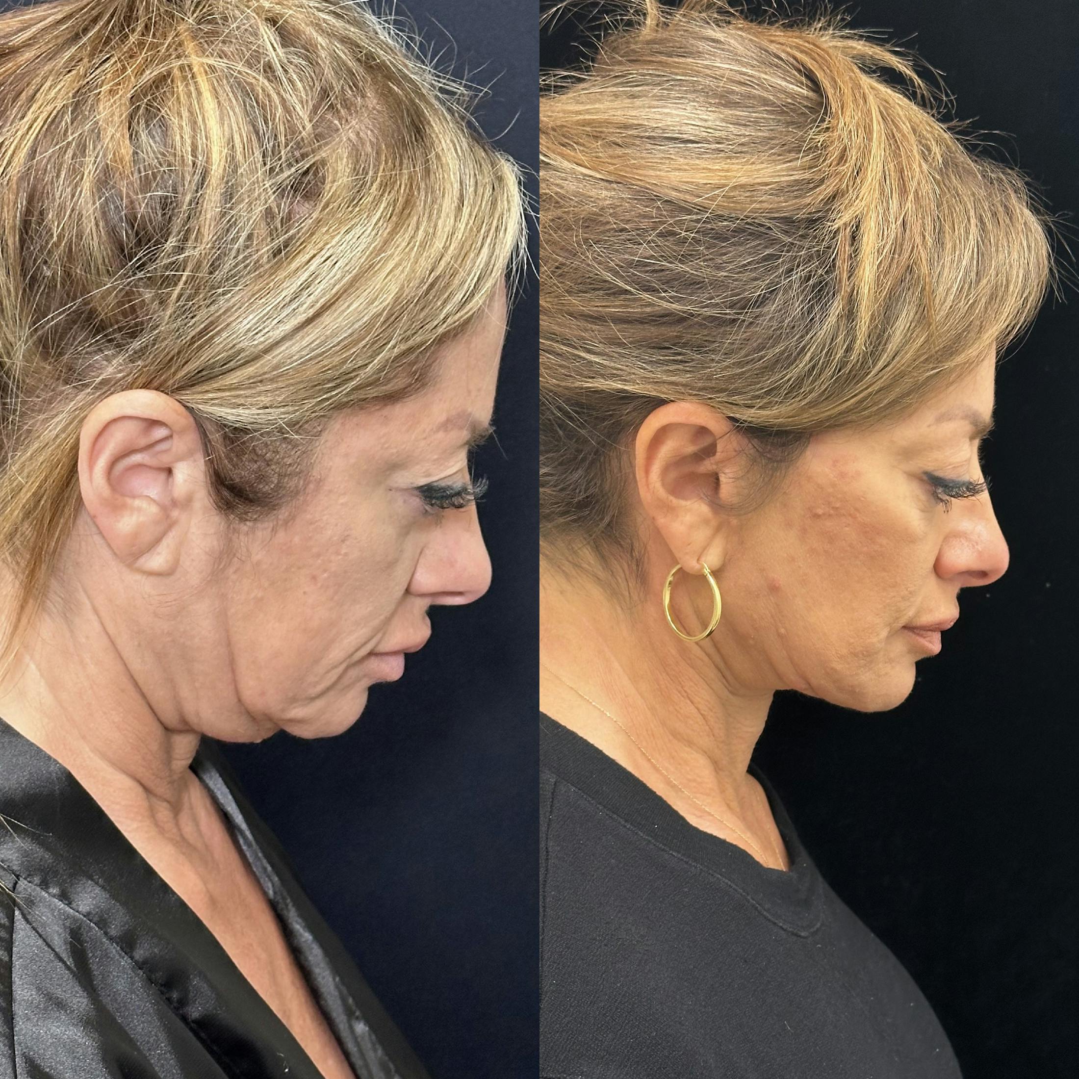 Deep Plane Facelift Before & After Gallery - Patient 151516 - Image 4