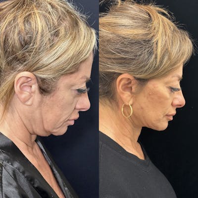Deep Plane Facelift Before & After Gallery - Patient 151516 - Image 4