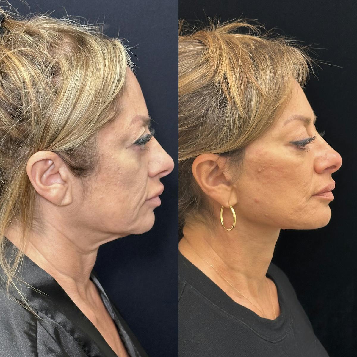 Deep Plane Facelift Before & After Gallery - Patient 151516 - Image 3