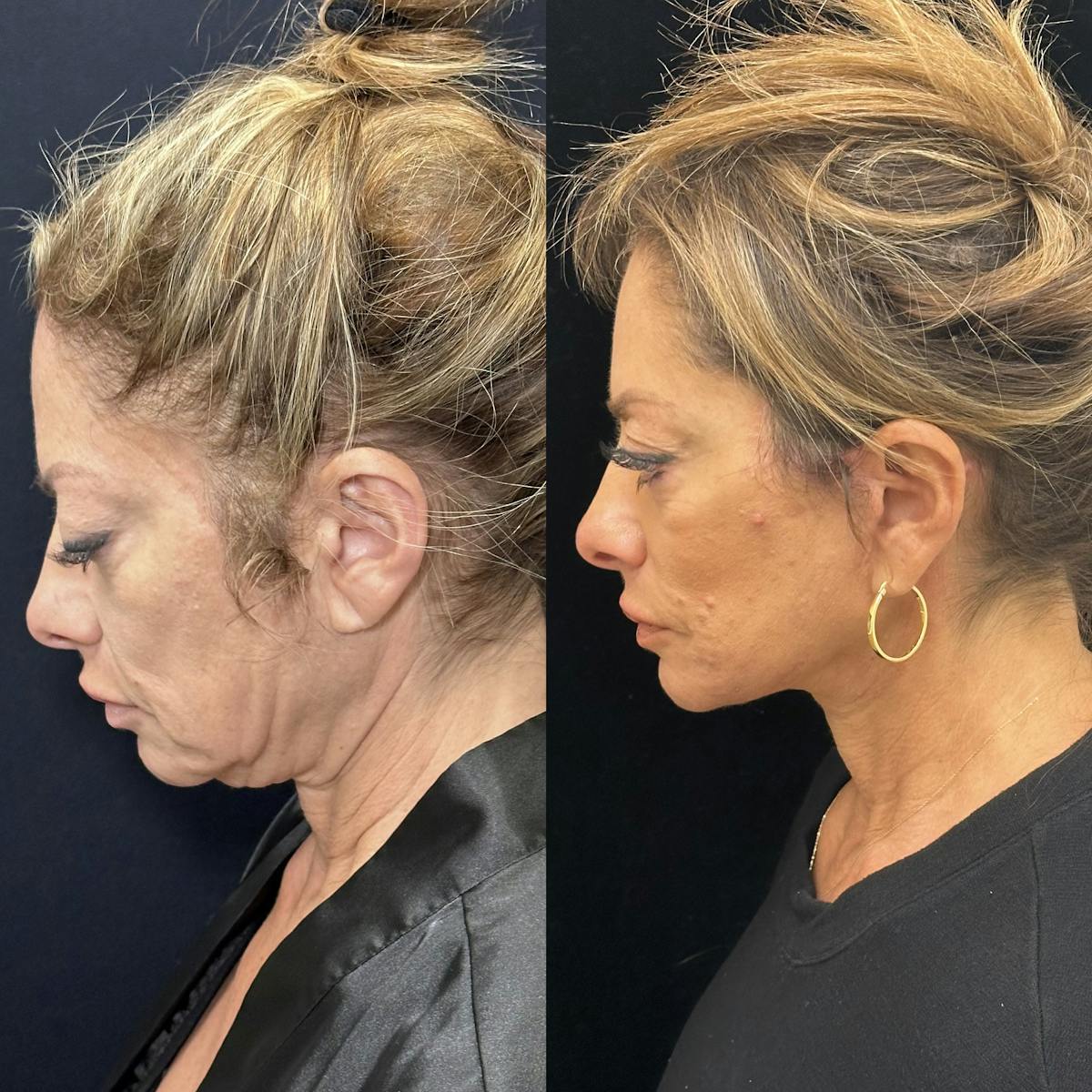 Deep Plane Facelift Before & After Gallery - Patient 151516 - Image 7