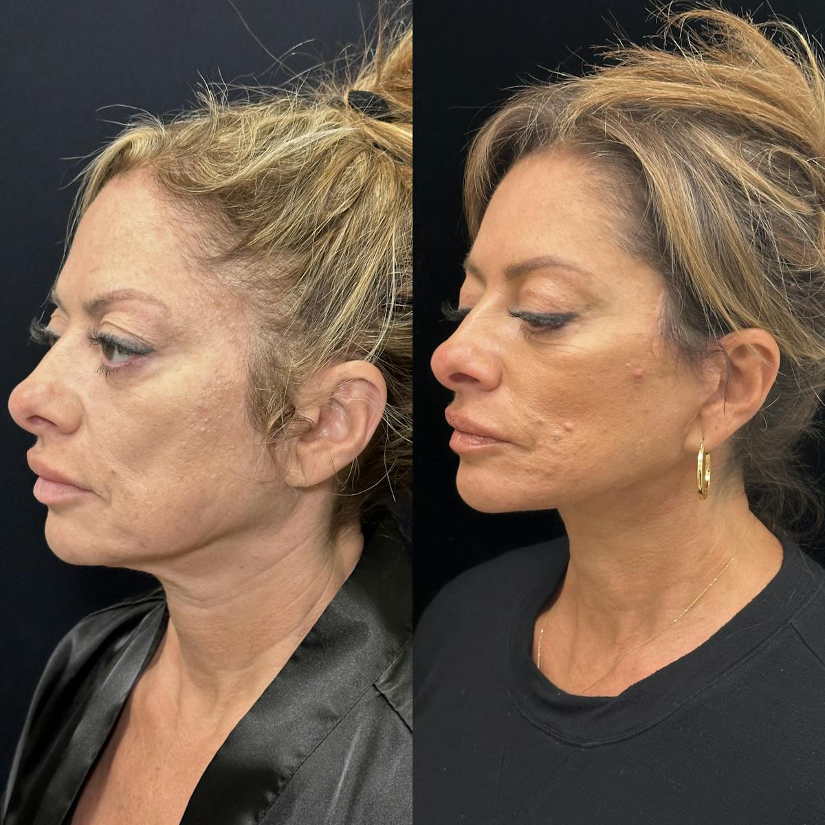 Deep Plane Facelift Before & After Gallery - Patient 151516 - Image 5