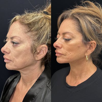 Deep Plane Facelift Before & After Gallery - Patient 151516 - Image 5