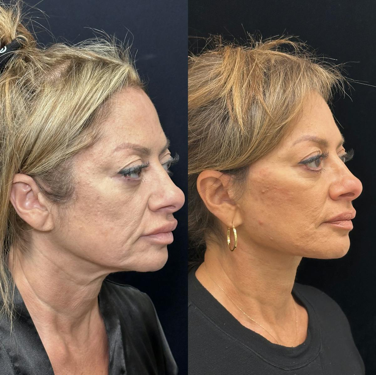 Deep Plane Facelift Before & After Gallery - Patient 151516 - Image 2