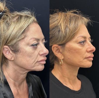 Deep Plane Facelift Before & After Gallery - Patient 151516 - Image 2