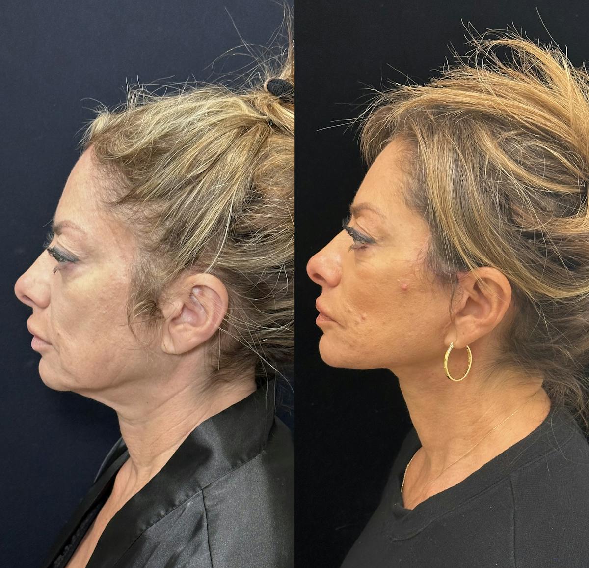 Deep Plane Facelift Before & After Gallery - Patient 151516 - Image 6