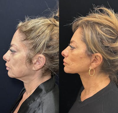 Deep Plane Facelift Before & After Gallery - Patient 151516 - Image 6