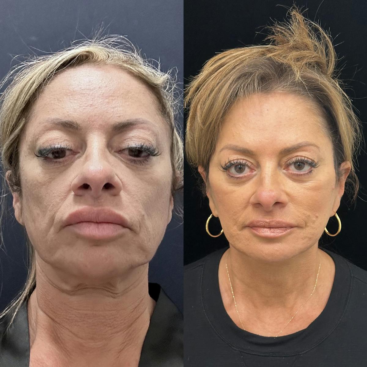 Deep Plane Facelift Before & After Gallery - Patient 151516 - Image 1
