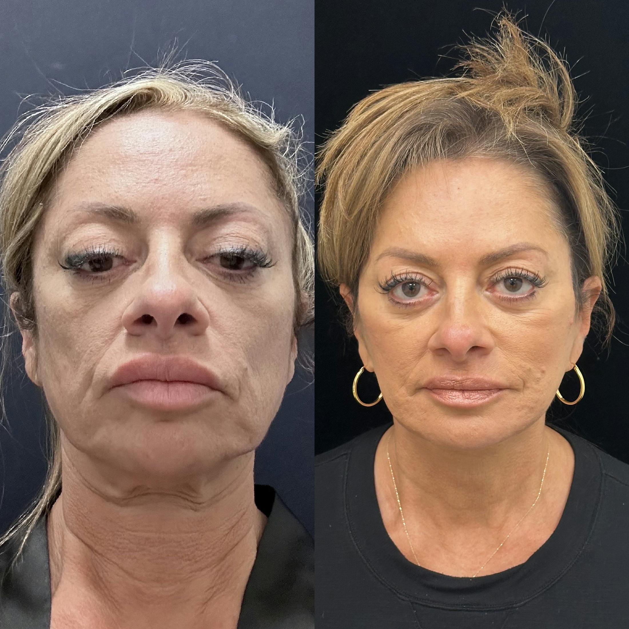 Deep Plane Facelift Before & After Gallery - Patient 151516 - Image 1