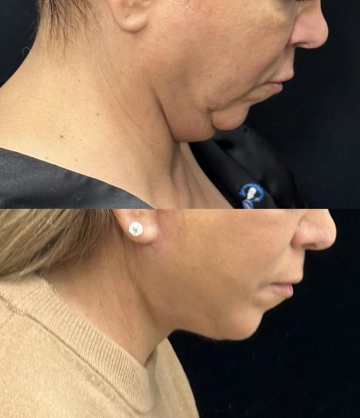 Deep Plane Facelift Before & After Gallery - Patient 397014 - Image 1