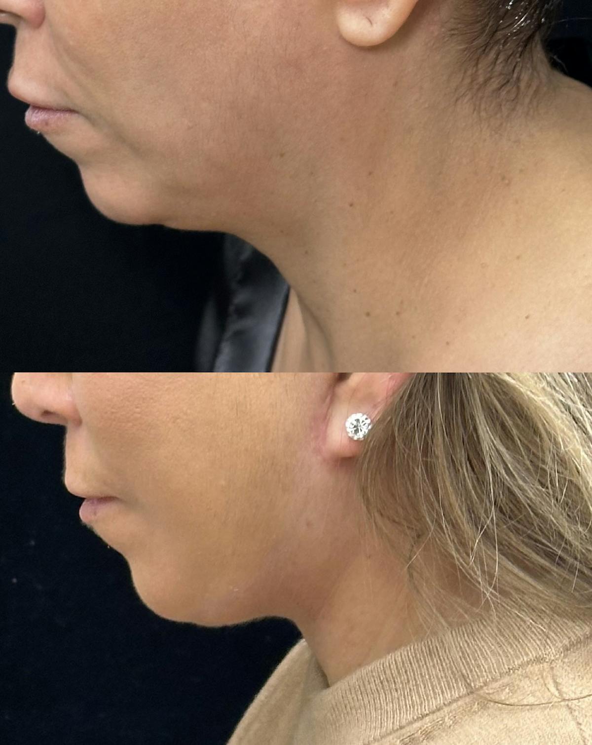 Deep Plane Facelift Before & After Gallery - Patient 397014 - Image 6