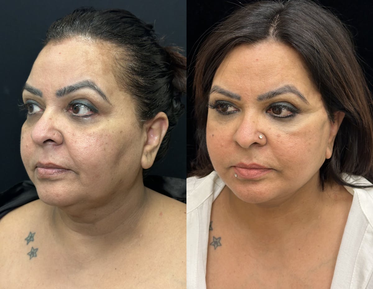 Deep Plane Facelift Before & After Gallery - Patient 397014 - Image 4