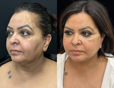 Deep Plane Facelift Before & After Gallery - Patient 397014 - Image 4