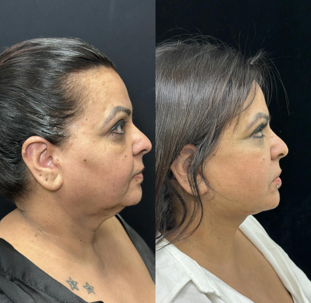 Deep Plane Facelift Before & After Gallery - Patient 397014 - Image 3