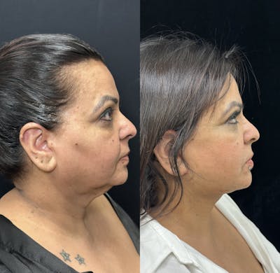 Deep Plane Facelift Before & After Gallery - Patient 397014 - Image 3