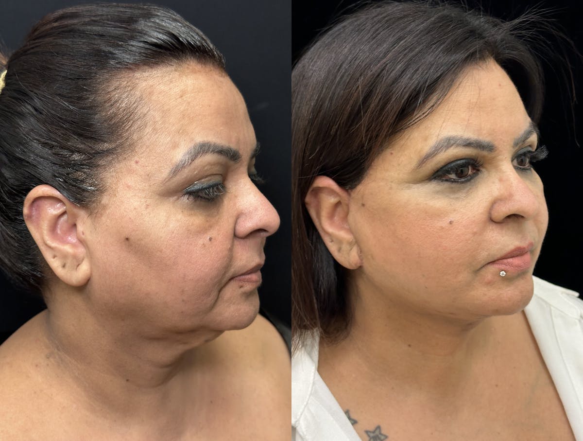Deep Plane Facelift Before & After Gallery - Patient 397014 - Image 2
