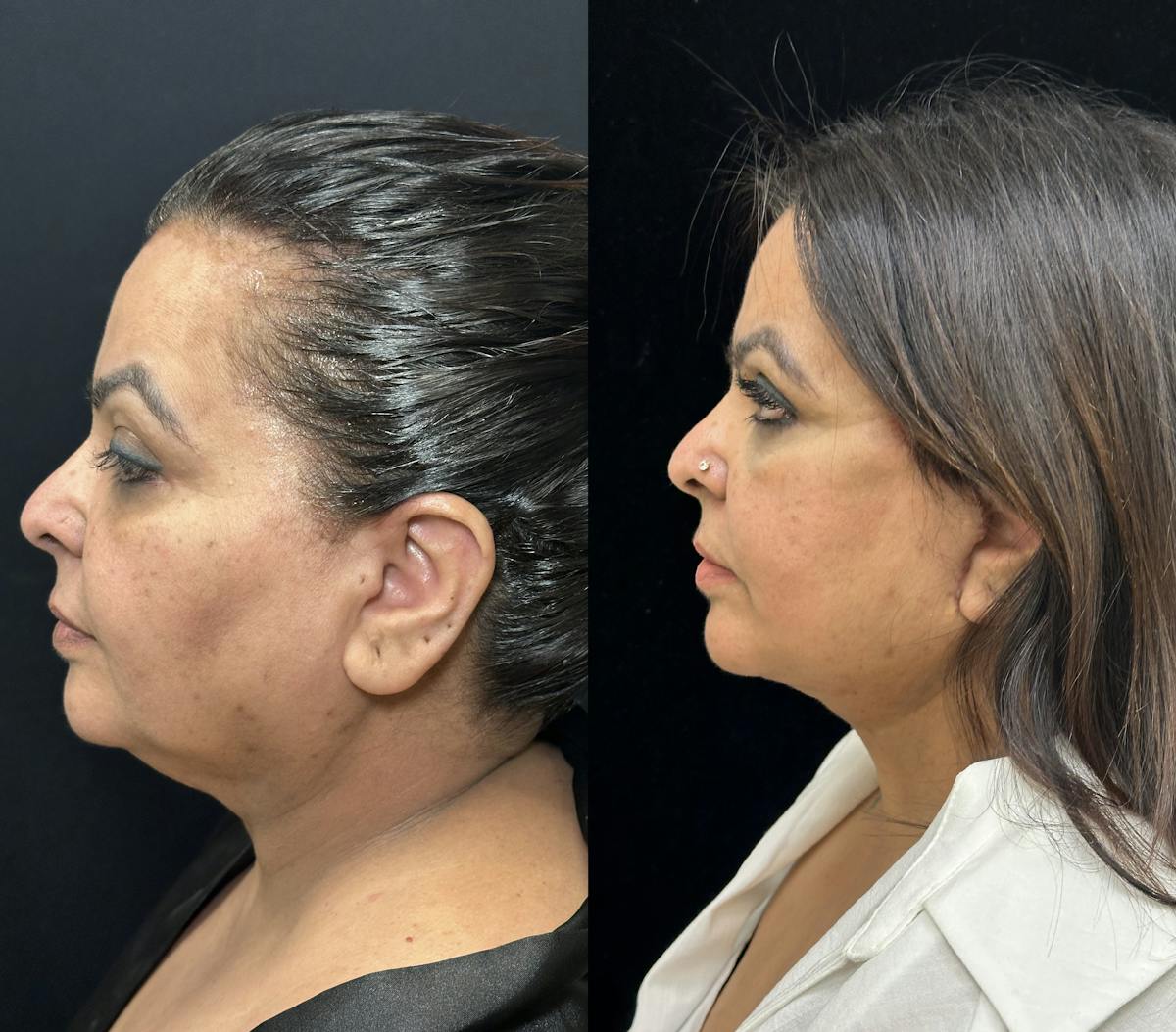 Deep Plane Facelift Before & After Gallery - Patient 397014 - Image 5