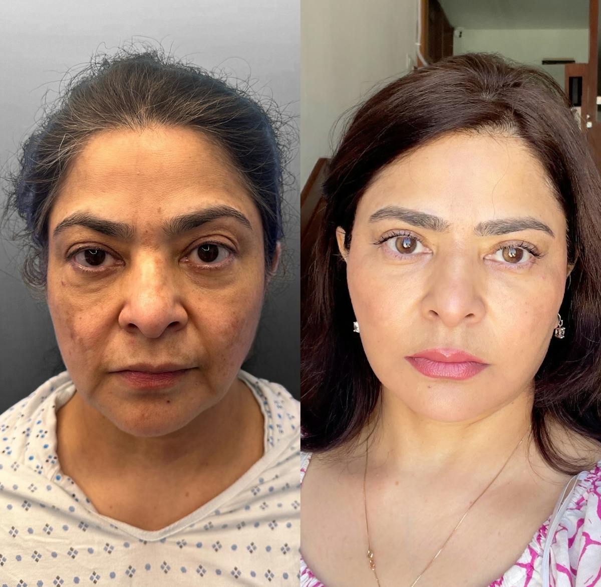Deep Plane Facelift Before & After Gallery - Patient 176814 - Image 1