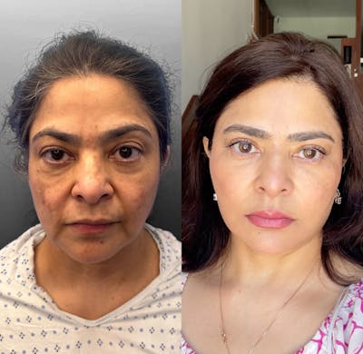 Deep Plane Facelift Before & After Gallery - Patient 176814 - Image 1