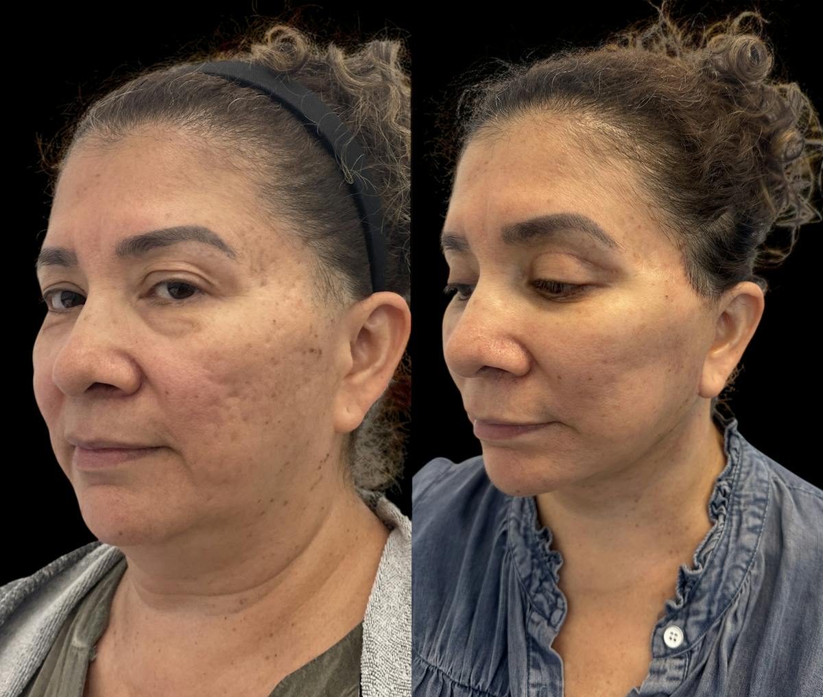 Deep Plane Facelift Before & After Gallery - Patient 180827 - Image 2