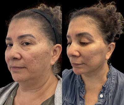 Deep Plane Facelift Before & After Gallery - Patient 180827 - Image 2