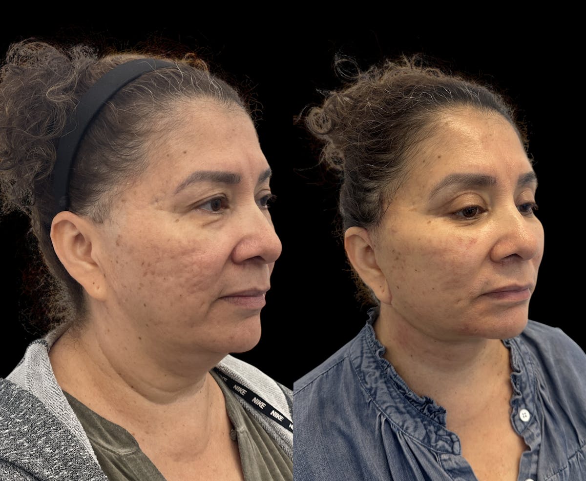 Deep Plane Facelift Before & After Gallery - Patient 180827 - Image 1