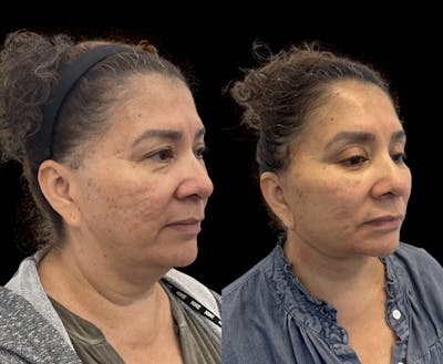 Deep Plane Facelift Before & After Gallery - Patient 180827 - Image 1