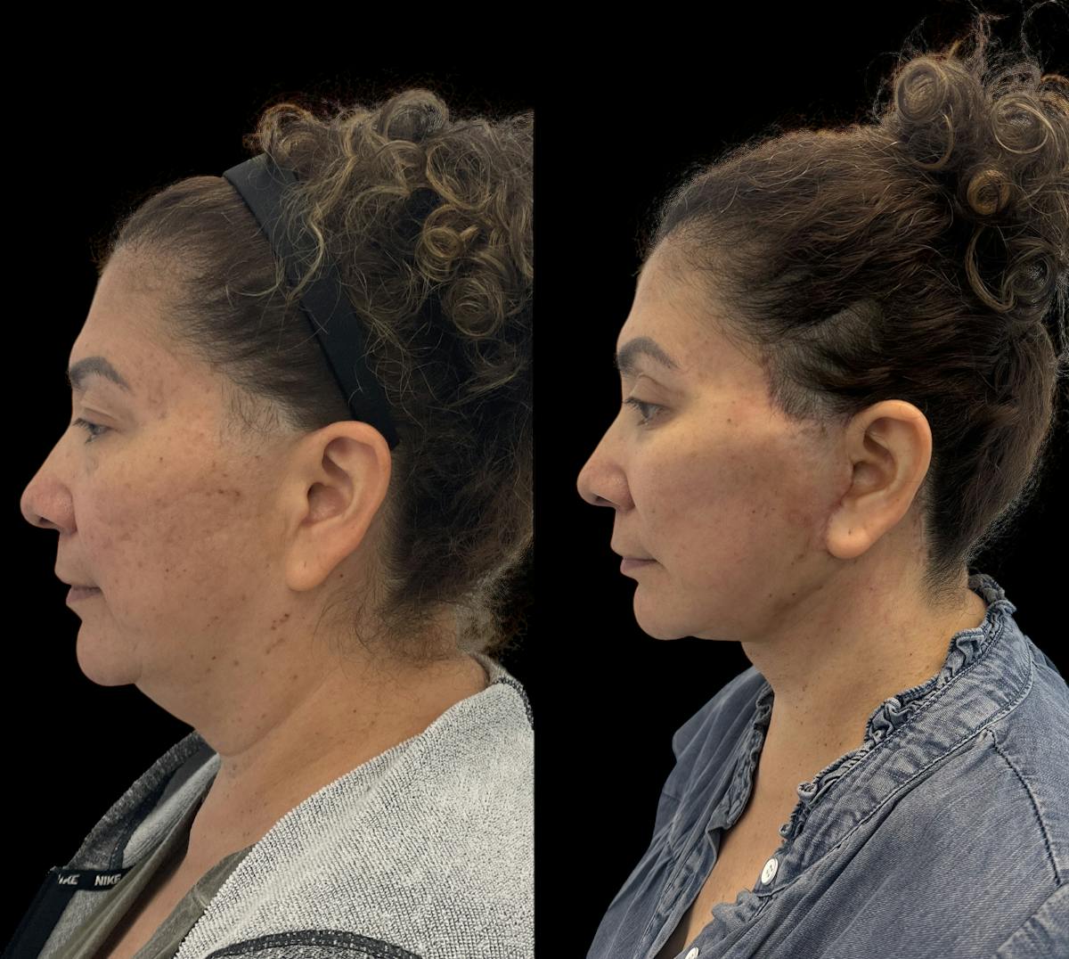 Deep Plane Facelift Before & After Gallery - Patient 180827 - Image 3