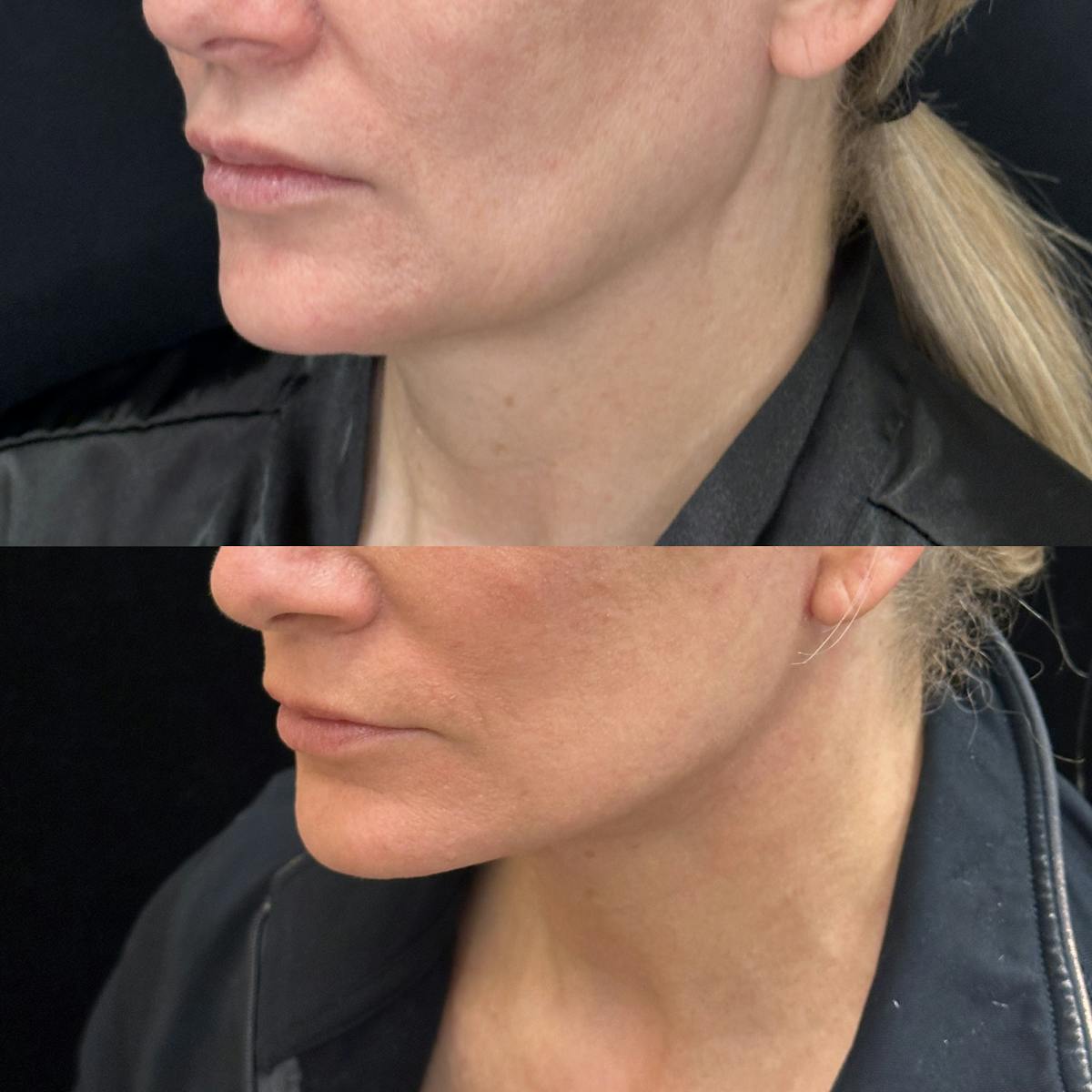 Deep Plane Facelift Before & After Gallery - Patient 378522 - Image 2