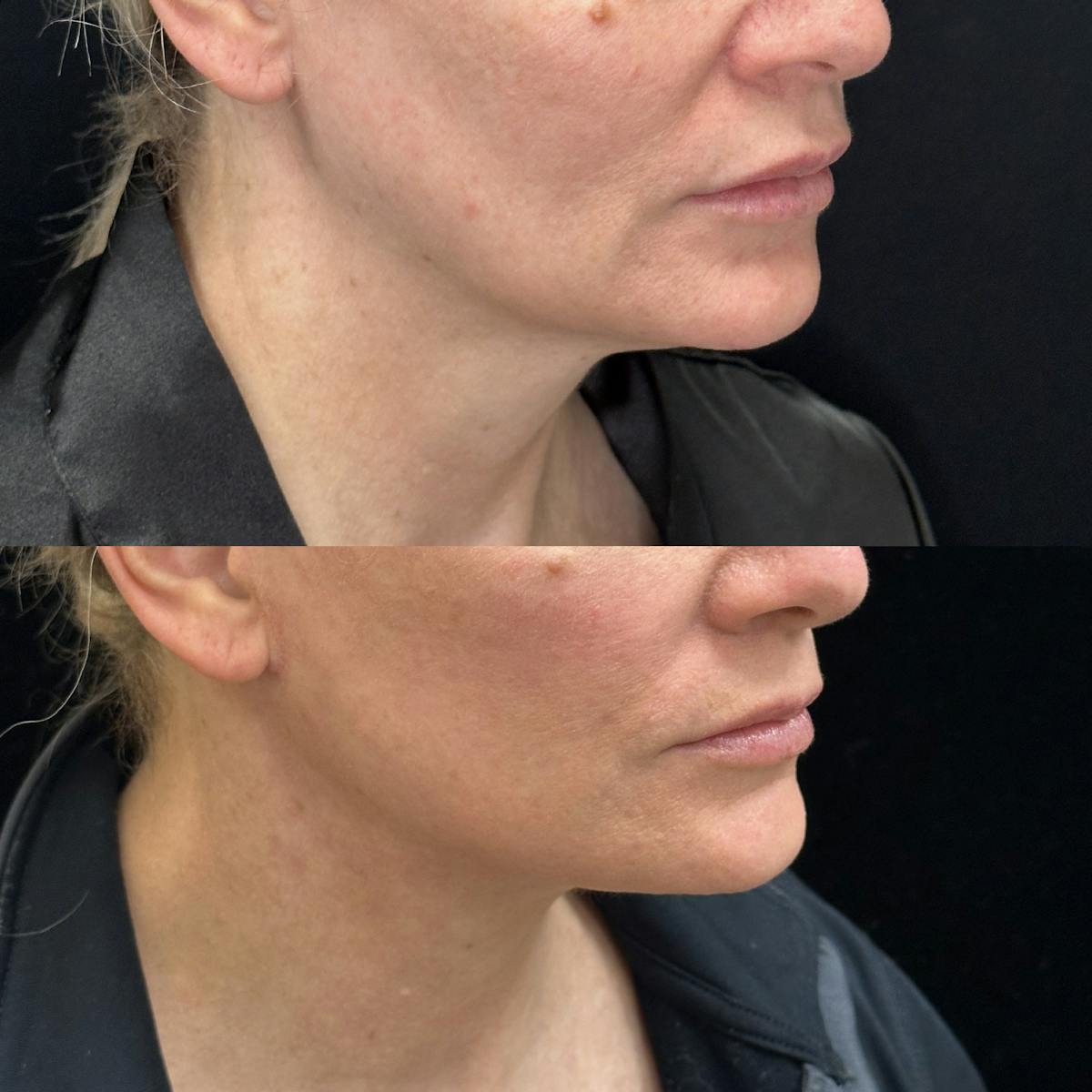 Deep Plane Facelift Before & After Gallery - Patient 378522 - Image 1