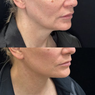 Deep Plane Facelift Before & After Gallery - Patient 378522 - Image 1
