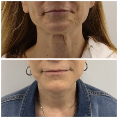 Deep Plane Facelift Before & After Gallery - Patient 134875 - Image 1