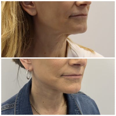 Deep Plane Facelift Before & After Gallery - Patient 134875 - Image 2