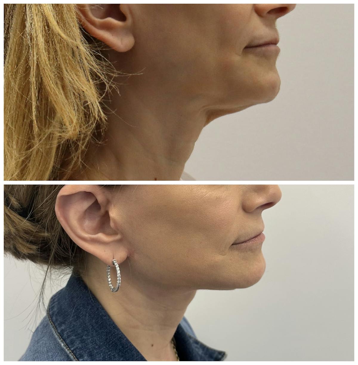 Deep Plane Facelift Before & After Gallery - Patient 134875 - Image 3