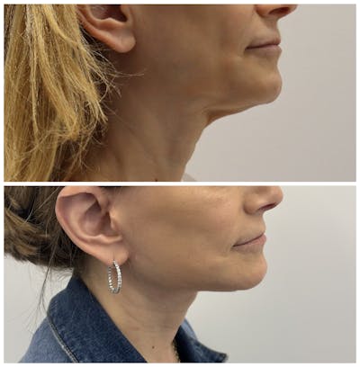 Deep Plane Facelift Before & After Gallery - Patient 134875 - Image 3