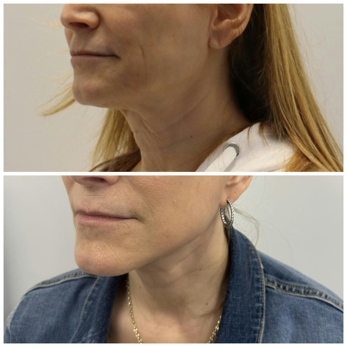 Deep Plane Facelift Before & After Gallery - Patient 134875 - Image 4