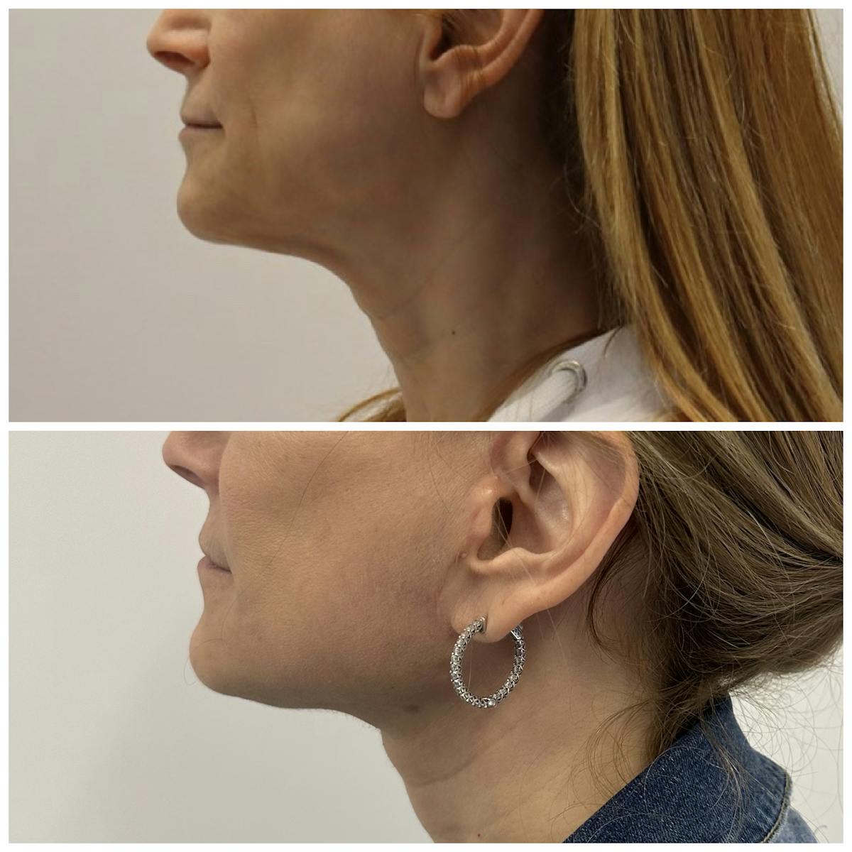 Deep Plane Facelift Before & After Gallery - Patient 134875 - Image 5