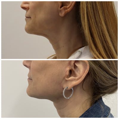 Deep Plane Facelift Before & After Gallery - Patient 134875 - Image 5