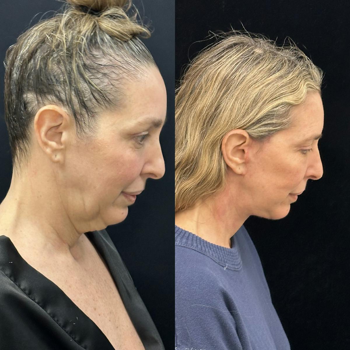 Deep Plane Facelift Before & After Gallery - Patient 301613 - Image 2
