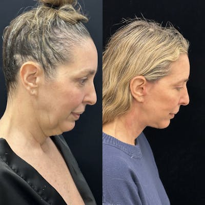 Deep Plane Facelift Before & After Gallery - Patient 301613 - Image 2