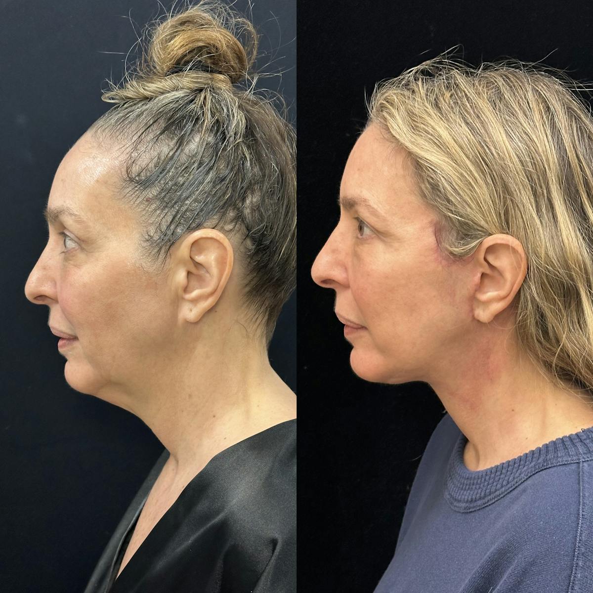 Deep Plane Facelift Before & After Gallery - Patient 301613 - Image 4