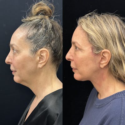 Deep Plane Facelift Before & After Gallery - Patient 301613 - Image 4