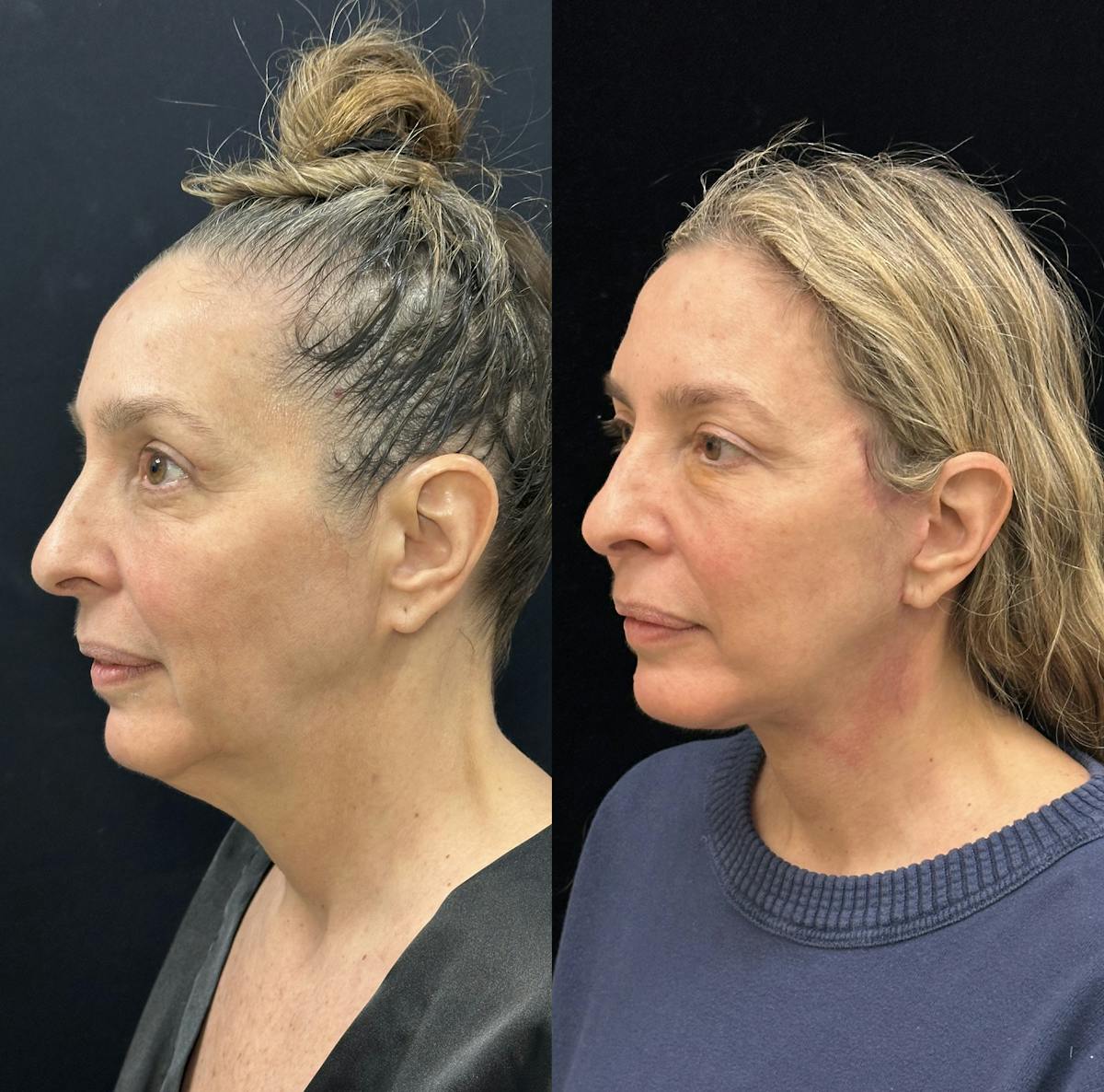Deep Plane Facelift Before & After Gallery - Patient 301613 - Image 3