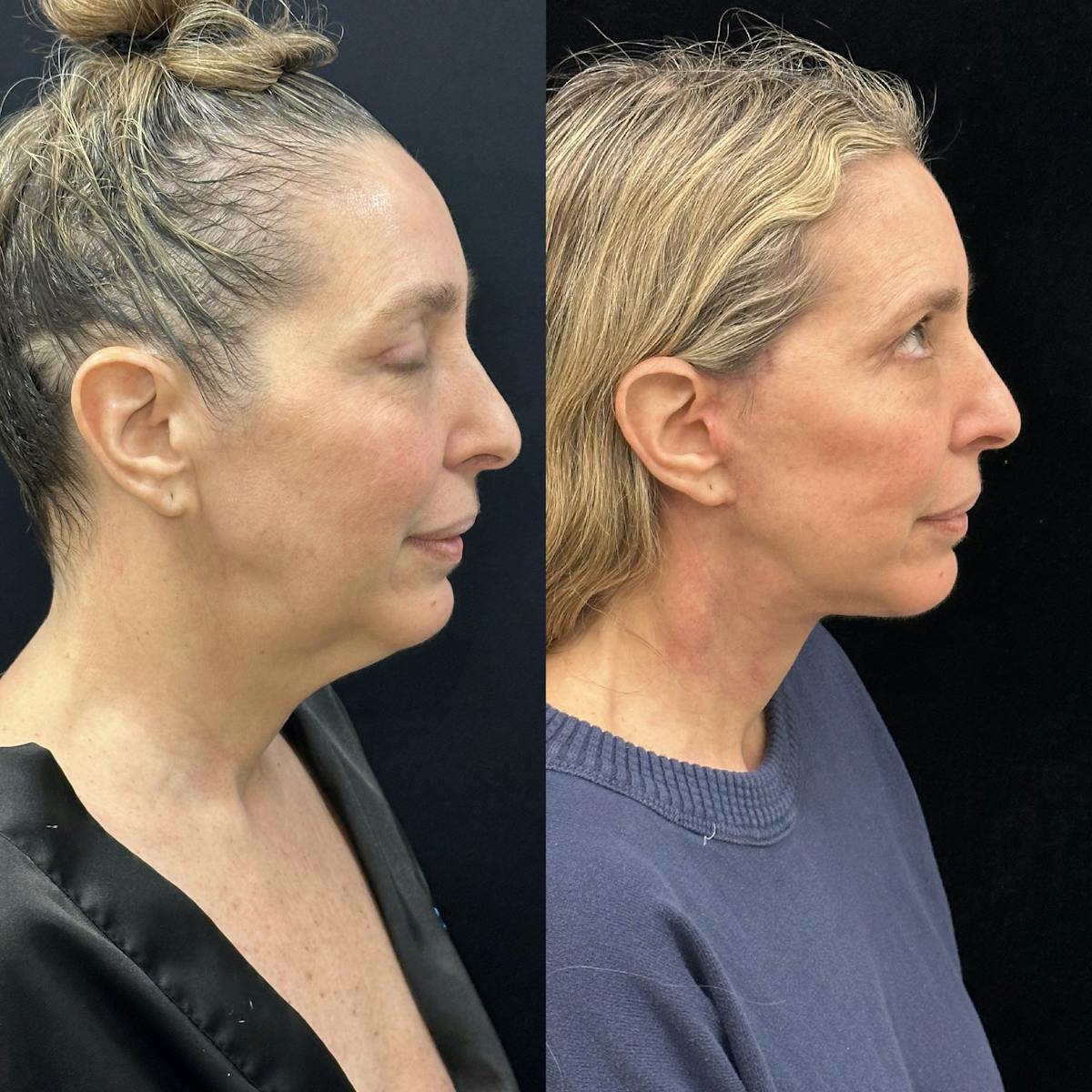 Deep Plane Facelift Before & After Gallery - Patient 301613 - Image 1