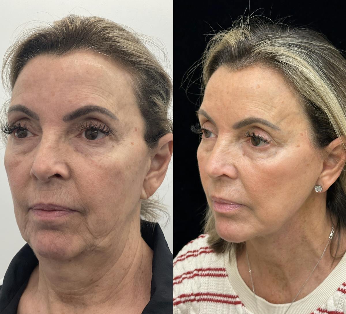 Deep Plane Facelift Before & After Gallery - Patient 141590 - Image 3