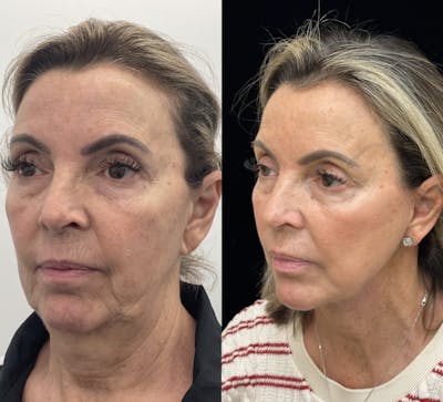 Deep Plane Facelift Before & After Gallery - Patient 141590 - Image 3