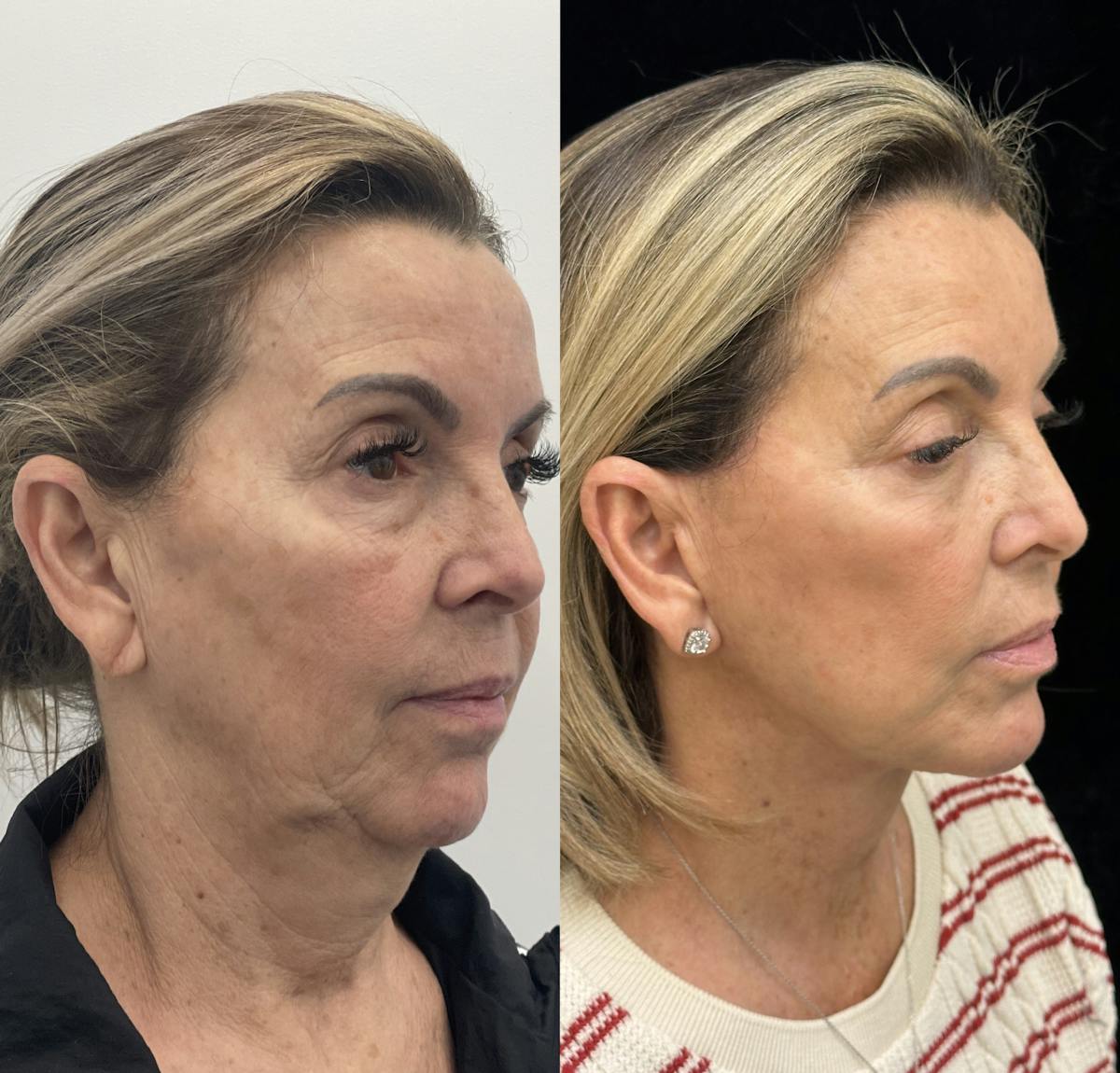 Deep Plane Facelift Before & After Gallery - Patient 141590 - Image 1