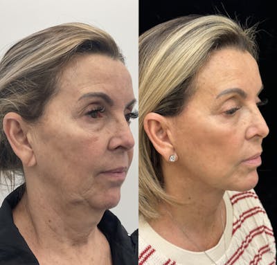 Deep Plane Facelift Before & After Gallery - Patient 141590 - Image 1