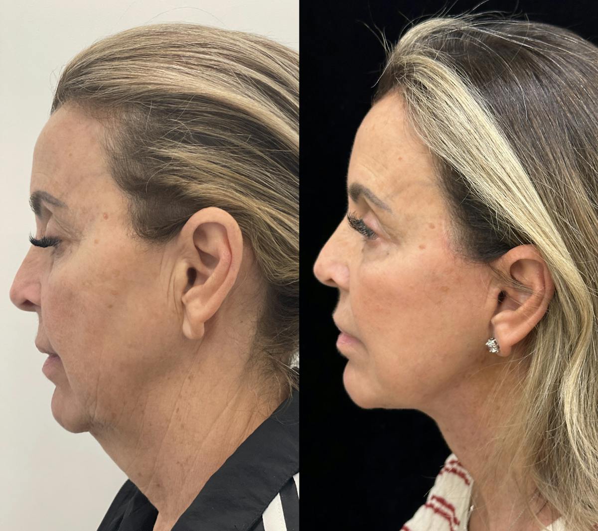 Deep Plane Facelift Before & After Gallery - Patient 141590 - Image 4