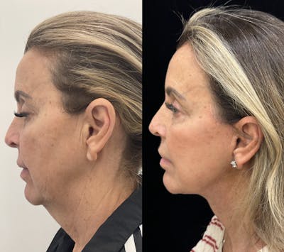 Deep Plane Facelift Before & After Gallery - Patient 141590 - Image 4